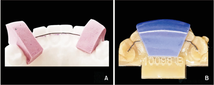 Innovative customized CAD/CAM nickel-titanium lingual retainer versus standard stainless-steel lingual retainer: A randomized controlled trial.