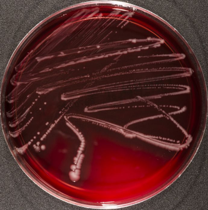 Wound infection caused by Photobacterium damselae in a 32-year-old woman: case report and review of the literature.