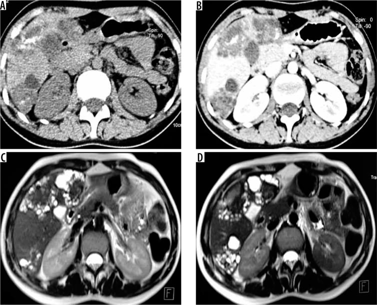 The spectrum of multimodality imaging findings in hepatic alveolar echinococcosis and the potential role of diffusion-weighted imaging in its characterisation.