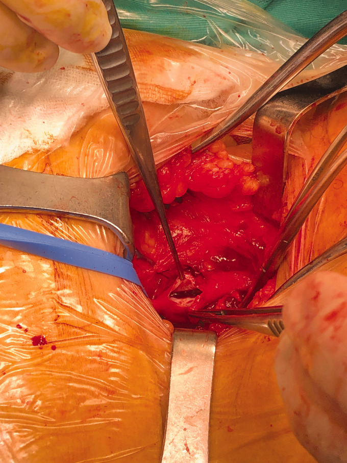 Pulmonary embolism: Successful treatment of floating thrombus in SFJ after vena cava filter insertion and surgical thrombectomy.