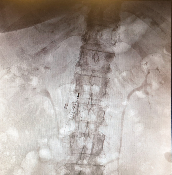 Pulmonary embolism: Successful treatment of floating thrombus in SFJ after vena cava filter insertion and surgical thrombectomy.