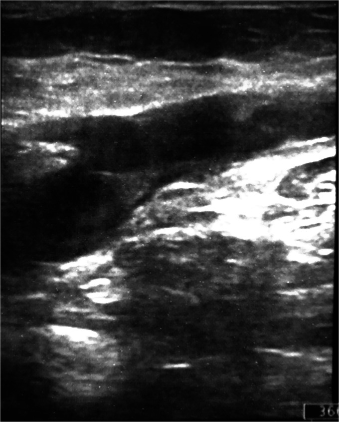 Pulmonary embolism: Successful treatment of floating thrombus in SFJ after vena cava filter insertion and surgical thrombectomy.