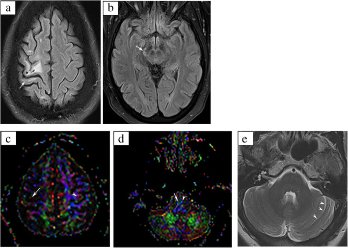 The complexity of eye-hand coordination: a perspective on cortico-cerebellar cooperation.