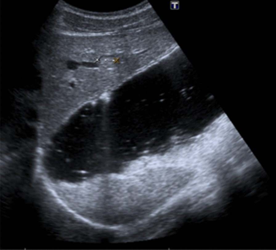 Simultaneous diagnosis of liver PEComa in a family with known Li-Fraumeni syndrome: a case report.