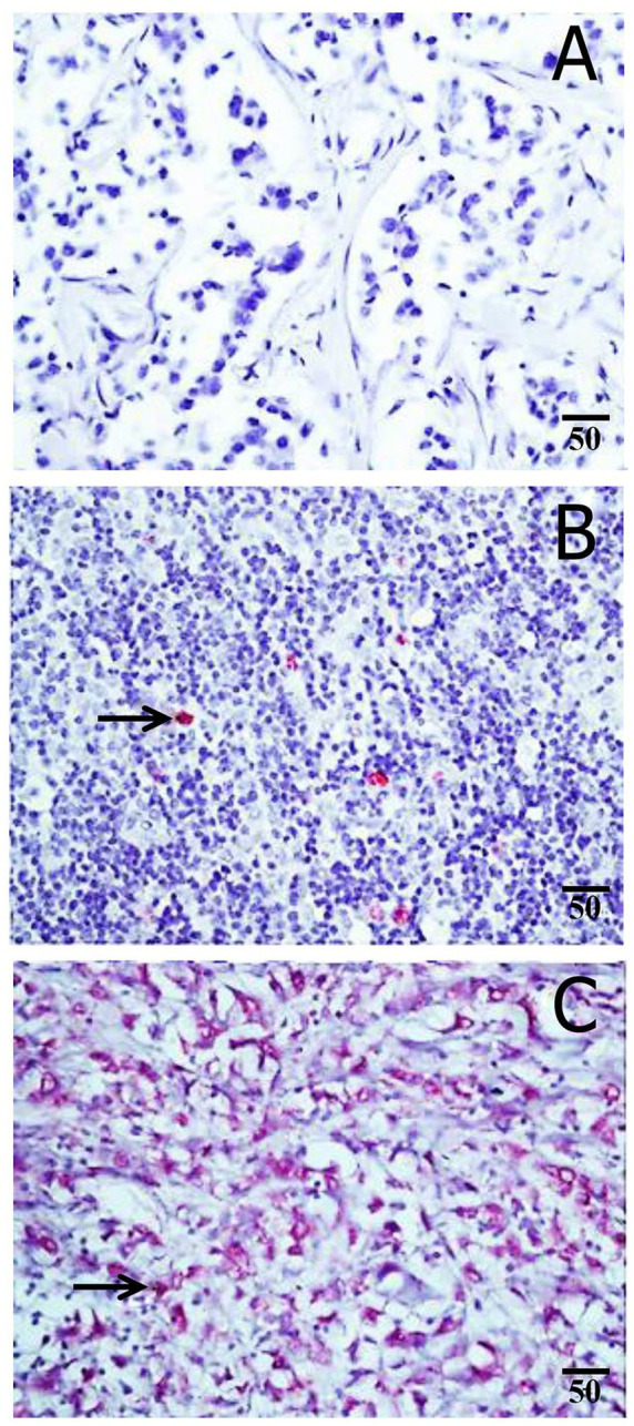 Human Mammary Tumor Virus, Human Papilloma Virus, and Epstein-Barr Virus Infection Are Associated With Sporadic Breast Cancer Metastasis.