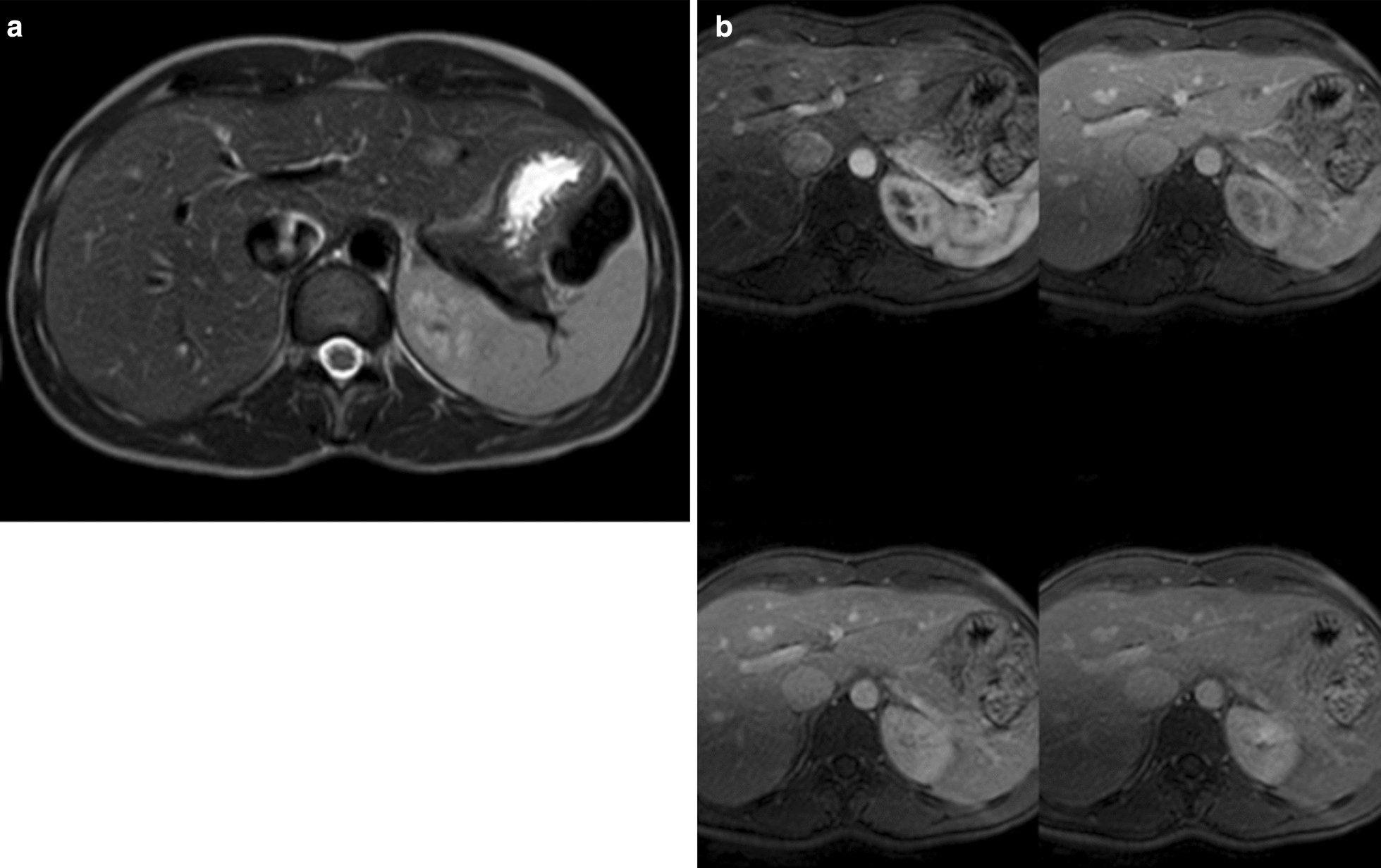 Simultaneous diagnosis of liver PEComa in a family with known Li-Fraumeni syndrome: a case report.