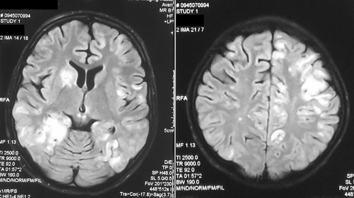 Castleman disease and SLE in a G6PD-deficient Marfan patient: a case report and literature review.