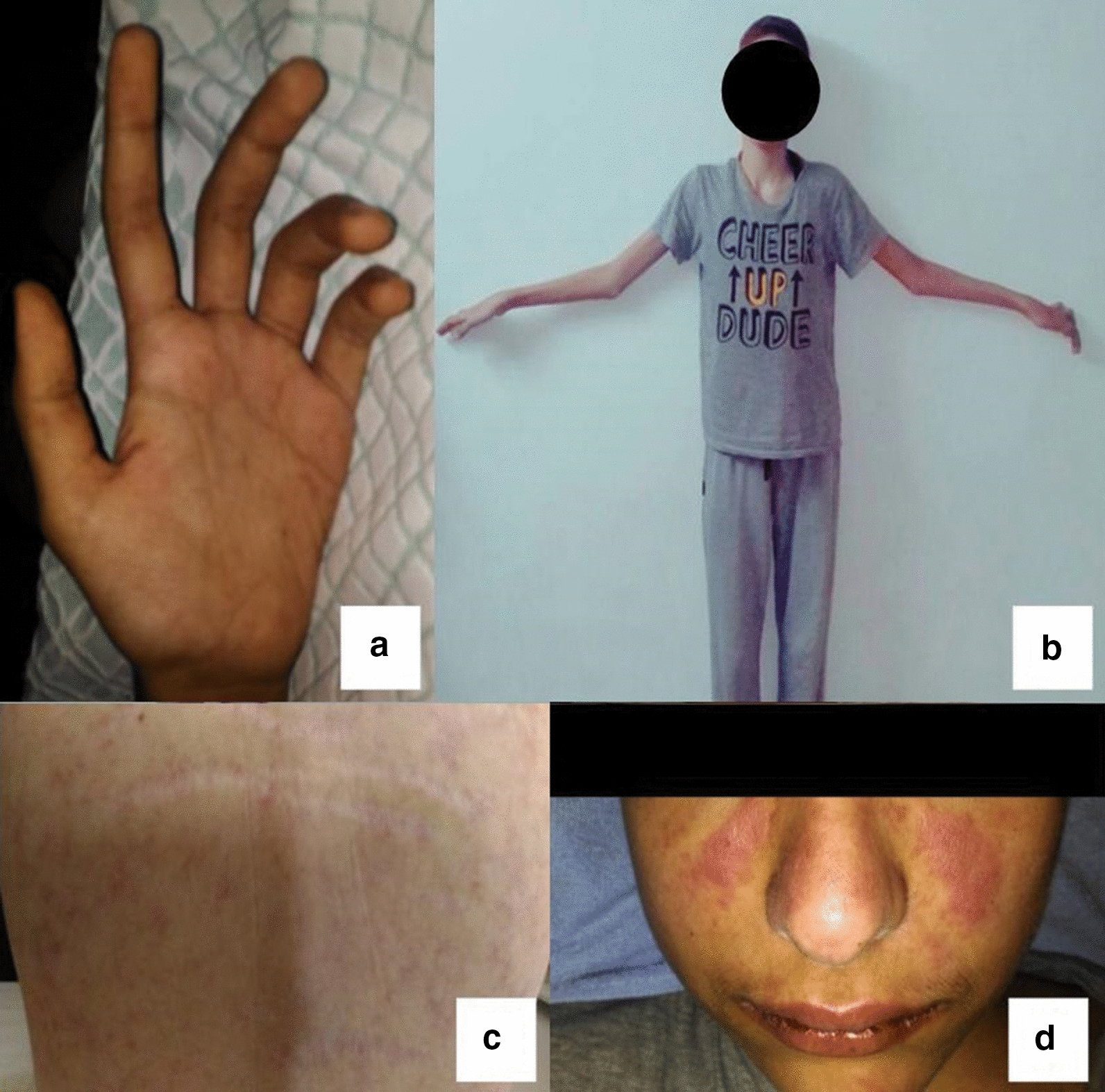 Castleman disease and SLE in a G6PD-deficient Marfan patient: a case report and literature review.