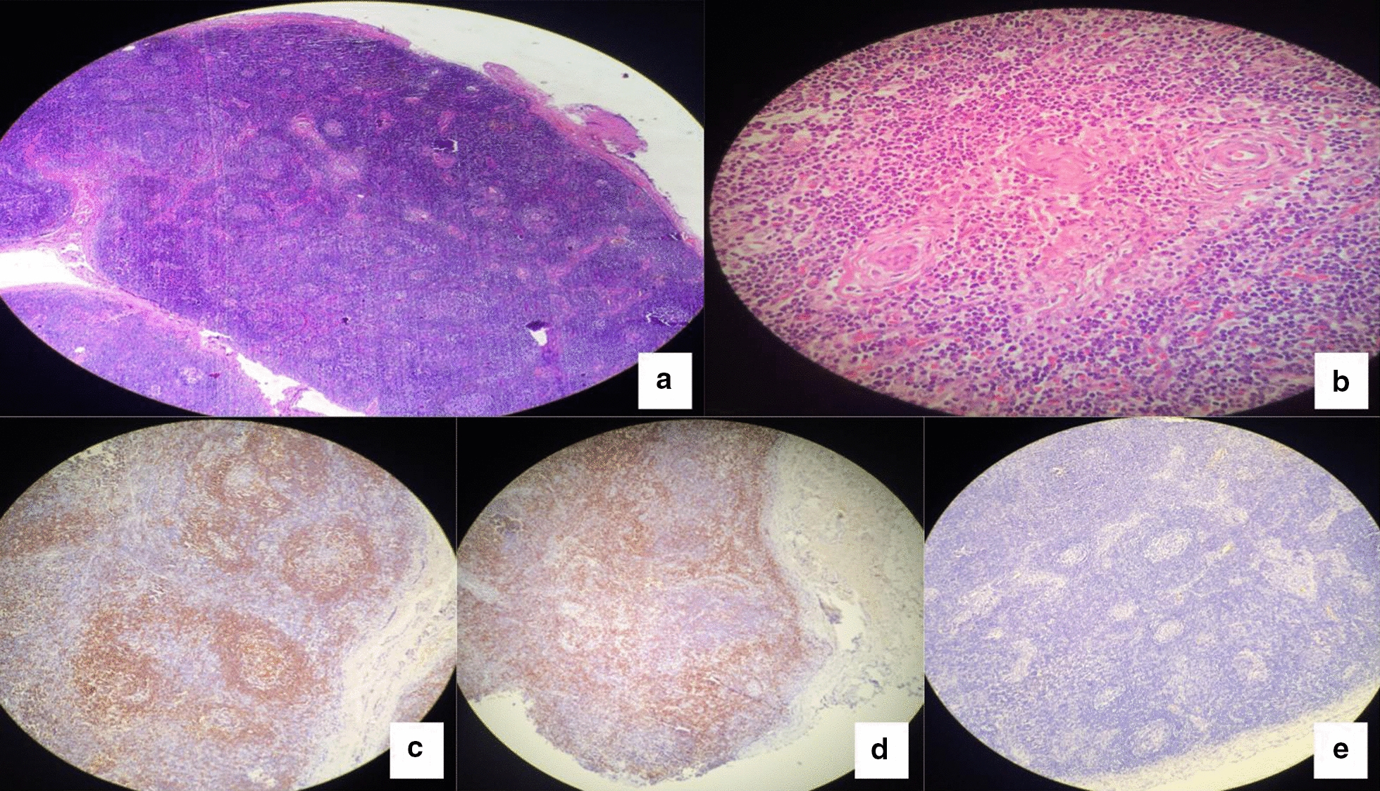 Castleman disease and SLE in a G6PD-deficient Marfan patient: a case report and literature review.