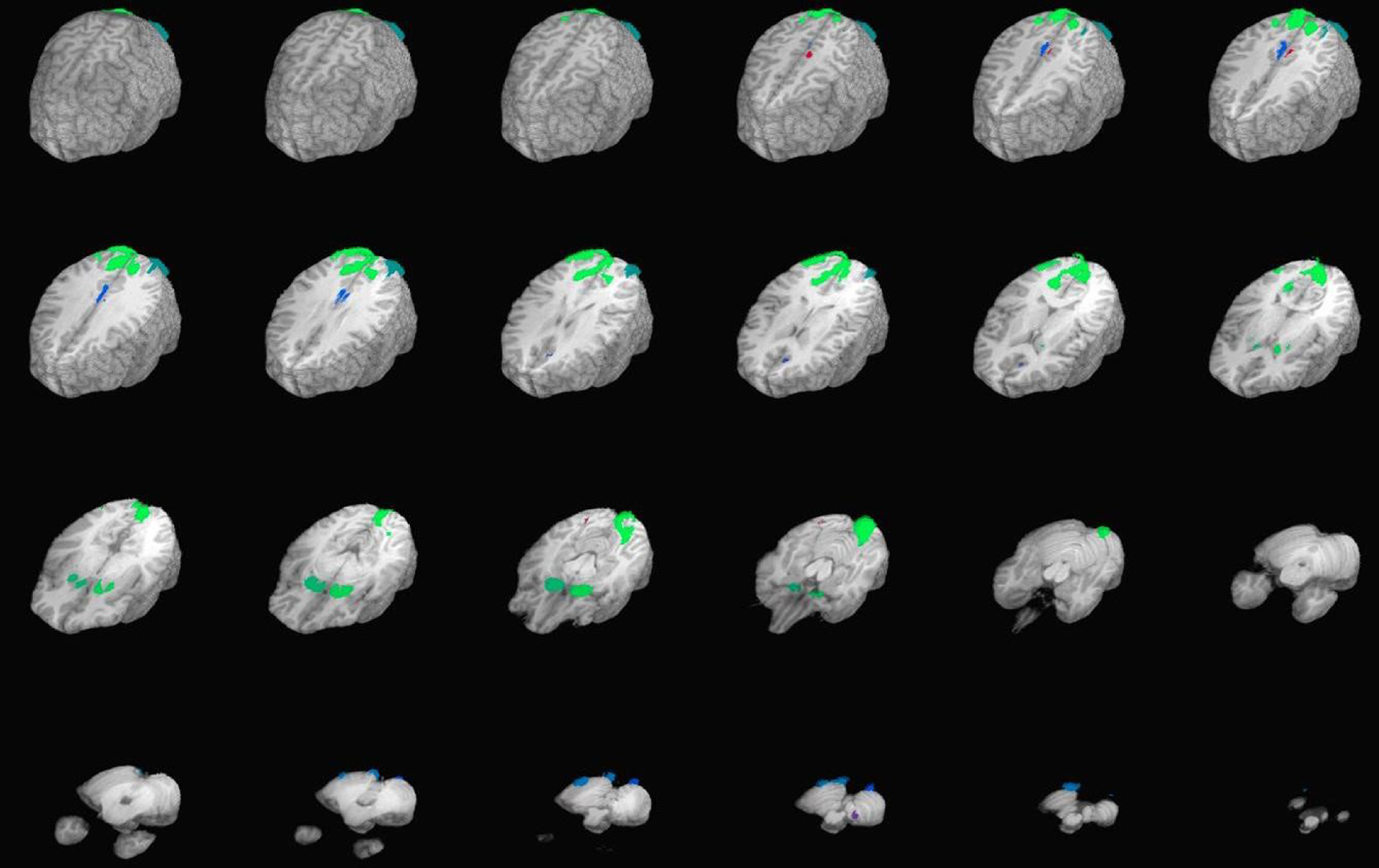 An fMRI investigation of the relations between Extraversion, internalizing psychopathology, and neural activation following reward receipt in the Human Connectome Project sample.