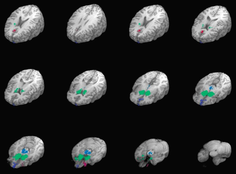 An fMRI investigation of the relations between Extraversion, internalizing psychopathology, and neural activation following reward receipt in the Human Connectome Project sample.