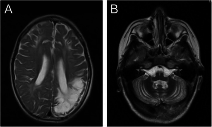 First case report of cerebral folate deficiency caused by a novel mutation of FOLR1 gene in a Chinese patient.