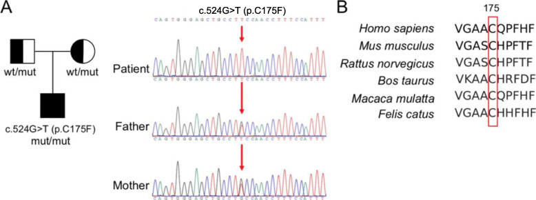 First case report of cerebral folate deficiency caused by a novel mutation of FOLR1 gene in a Chinese patient.