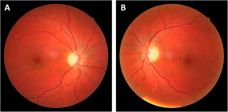 First submicroscopic inversion of the OPA1 gene identified in dominant optic atrophy - a case report.