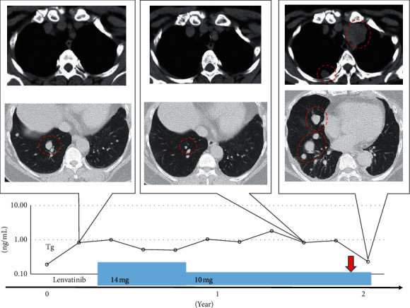 Three Cases of Anaplastic Thyroid Carcinoma Transformation and Leukocytosis during Lenvatinib Treatment.