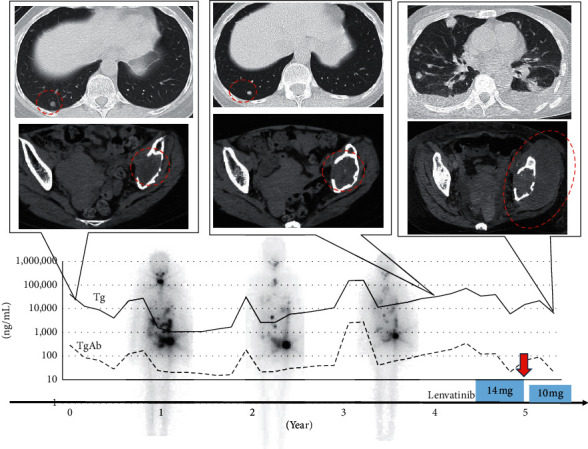 Three Cases of Anaplastic Thyroid Carcinoma Transformation and Leukocytosis during Lenvatinib Treatment.