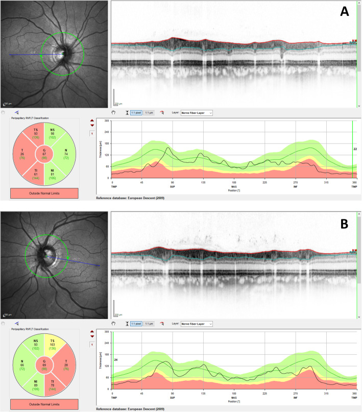 First submicroscopic inversion of the OPA1 gene identified in dominant optic atrophy - a case report.