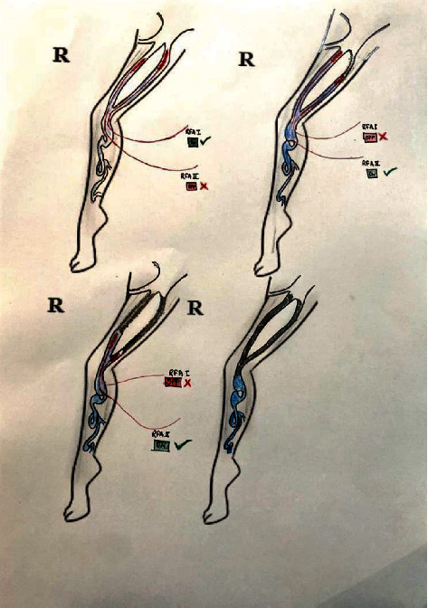 Interesting Scenarios during Radiofrequency Ablation of Varicose Veins at University Hospital of Nepal.