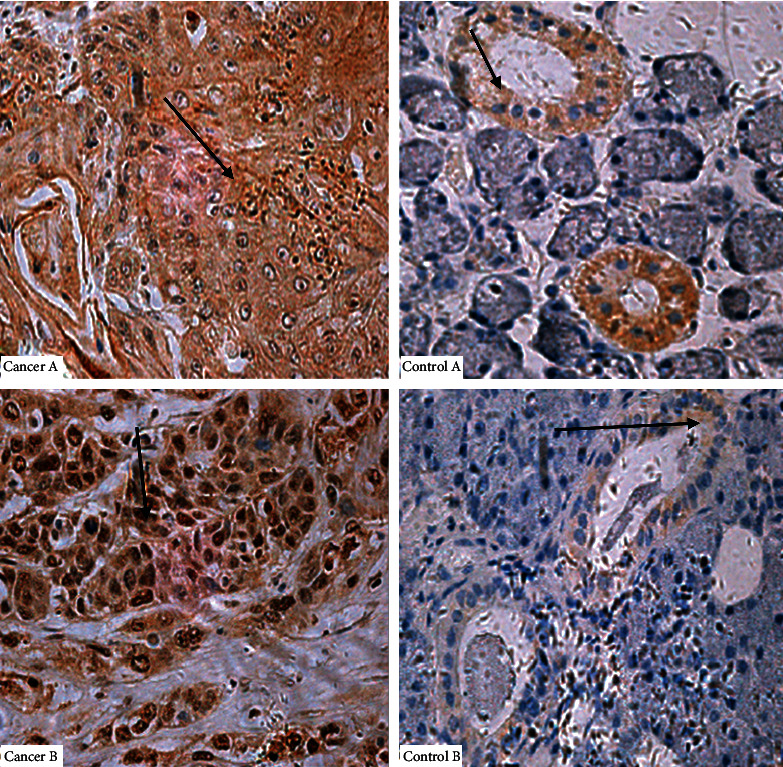 Prognostic Worth of Epidermal Growth Factor Receptor (EGFR) in Patients with Head and Neck Tumors.