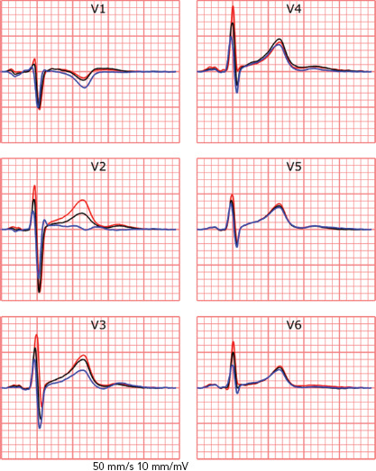 Big Data and Artificial Intelligence: Opportunities and Threats in Electrophysiology.