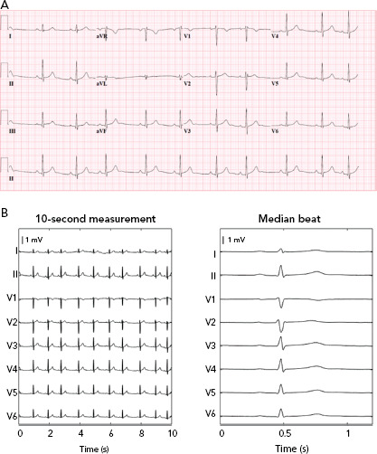 Big Data and Artificial Intelligence: Opportunities and Threats in Electrophysiology.