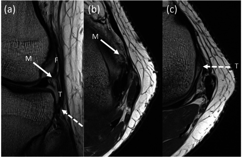 Timing of magnetic resonance imaging affects the accuracy and interobserver agreement of anterolateral ligament tears detection in anterior cruciate ligament deficient knees.