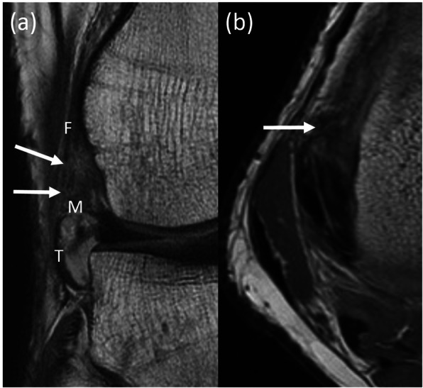 Timing of magnetic resonance imaging affects the accuracy and interobserver agreement of anterolateral ligament tears detection in anterior cruciate ligament deficient knees.