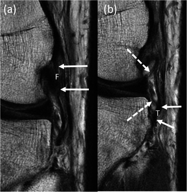 Timing of magnetic resonance imaging affects the accuracy and interobserver agreement of anterolateral ligament tears detection in anterior cruciate ligament deficient knees.