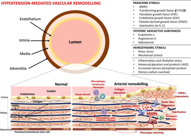 Matrix Metalloproteinases and Hypertension-Mediated Organ Damage: Current Insights.