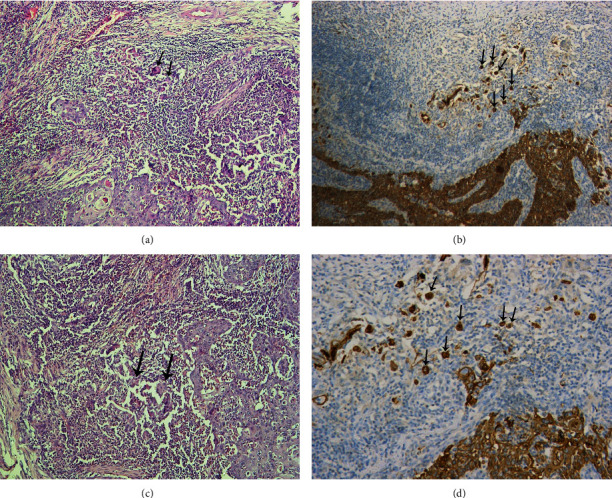 Evaluation of the Potential Prognostic Value of Tumor Budding in Laryngeal Carcinoma by Conventional and Immunohistochemical Staining.