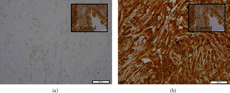 Clinicopathological and Molecular Characteristics of Pleomorphic Invasive Lobular Carcinoma.