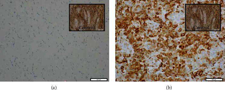 Clinicopathological and Molecular Characteristics of Pleomorphic Invasive Lobular Carcinoma.