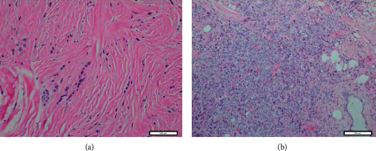 Clinicopathological and Molecular Characteristics of Pleomorphic Invasive Lobular Carcinoma.