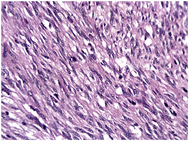 Histopathological Characteristics of Gastrointestinal Stromal Tumors in a Cohort of Vietnamese Patients.