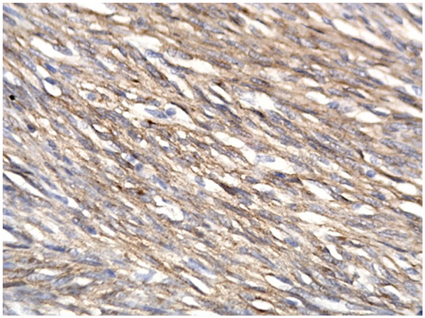 Histopathological Characteristics of Gastrointestinal Stromal Tumors in a Cohort of Vietnamese Patients.