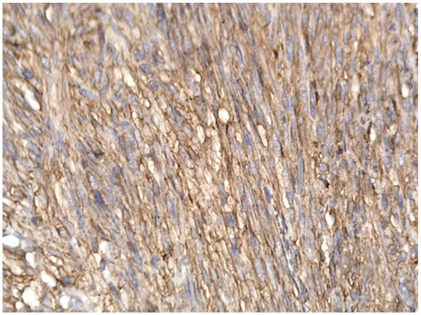 Histopathological Characteristics of Gastrointestinal Stromal Tumors in a Cohort of Vietnamese Patients.