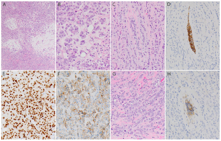 Pleomorphic Invasive Lobular Carcinoma of the Breast With Extracellular Mucin and <i>HER2</i> Amplification.