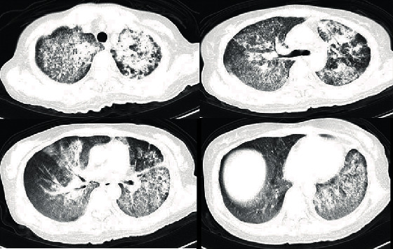 The First Case of L. pseudomesenteroides Pulmonary Infection and Literature Review.