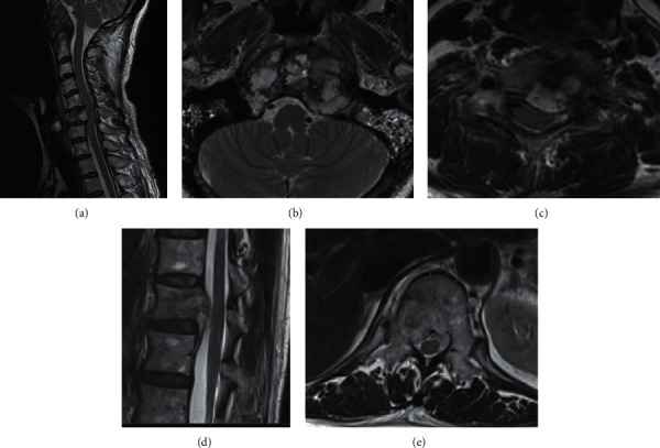 Genetic Testing Distinguishes Multiple Chondroid Chordomas with Neuraxial Bone Metastases from Multicentric Tumors.