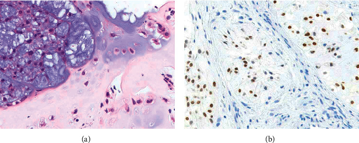 Genetic Testing Distinguishes Multiple Chondroid Chordomas with Neuraxial Bone Metastases from Multicentric Tumors.