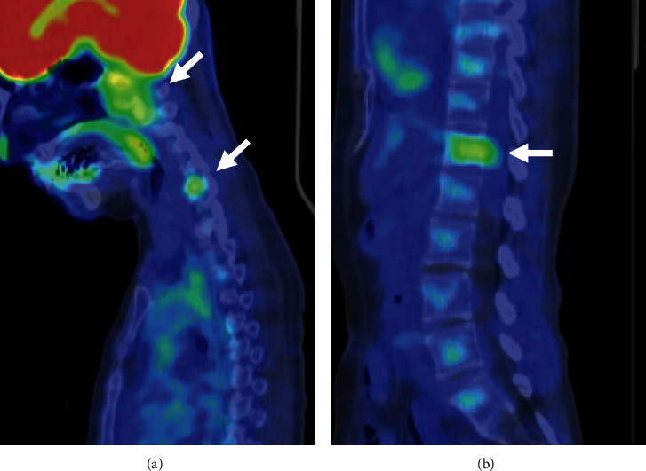 Genetic Testing Distinguishes Multiple Chondroid Chordomas with Neuraxial Bone Metastases from Multicentric Tumors.