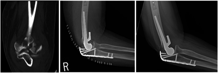 Distal Humerus Fractures Managed With Elbow Hemiarthroplasty.