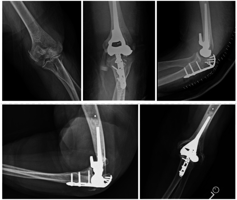 Distal Humerus Fractures Managed With Elbow Hemiarthroplasty.