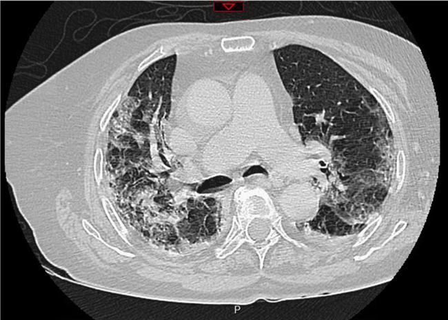 Limited effectiveness of systematic screening by nasopharyngeal RT-PCR of medicalized nursing home staff after a first case of COVID-19 in a resident