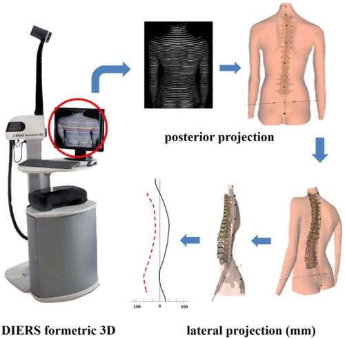 Dynamic testing of volleyball players' body posture using a formetric 3D device