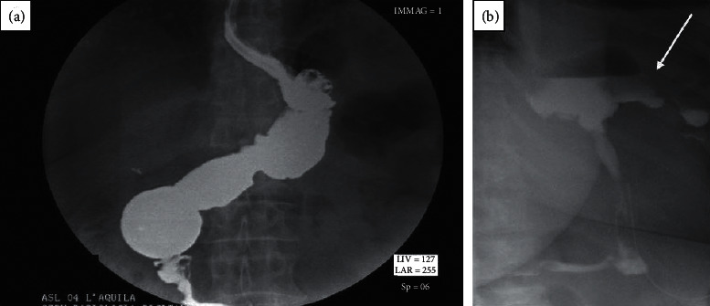 Endoscopic Double-Pigtail Catheter (EDPC) Internal Drainage as First-Line Treatment of Gastric Leak: A Case Series during Laparoscopic Sleeve Gastrectomy Learning Curve for Morbid Obesity.