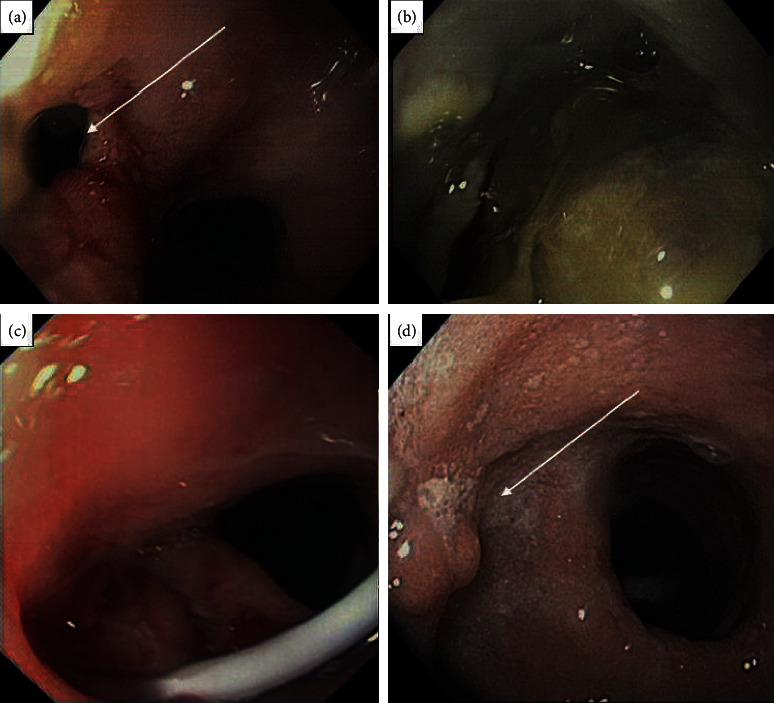 Endoscopic Double-Pigtail Catheter (EDPC) Internal Drainage as First-Line Treatment of Gastric Leak: A Case Series during Laparoscopic Sleeve Gastrectomy Learning Curve for Morbid Obesity.