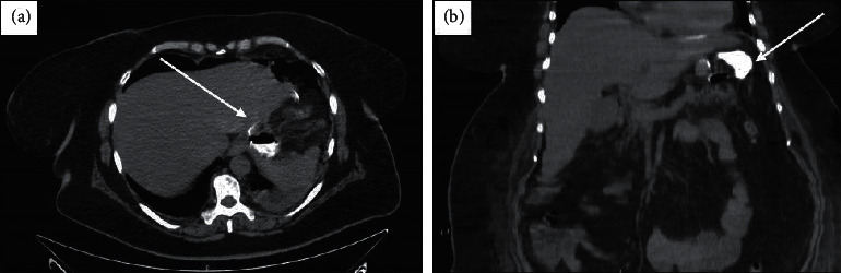 Endoscopic Double-Pigtail Catheter (EDPC) Internal Drainage as First-Line Treatment of Gastric Leak: A Case Series during Laparoscopic Sleeve Gastrectomy Learning Curve for Morbid Obesity.