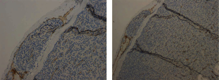 Parathyroid Carcinoma in the Setting of Tertiary Hyperparathyroidism: Case Report and Review of the Literature.