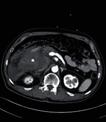 Coil Embolization of Arc of Buhler Aneurysm Rupture.